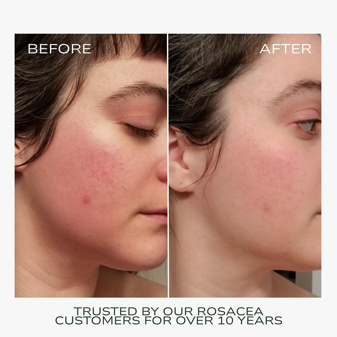 Fitglow Beauty | Redness Rescue Cream | Before and After Image - before and after images showing the appearance of facial redness on a white background