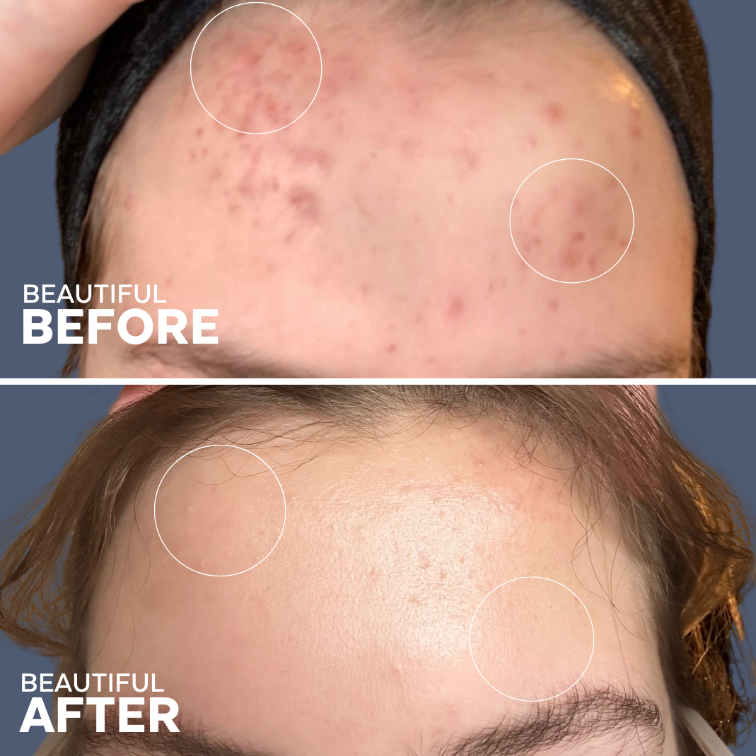 SkinHero Bakuchiol + Calendula Serum
