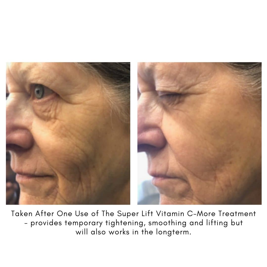 The Super Lift Vitamin C-More Treatment - Beauty Heroes®