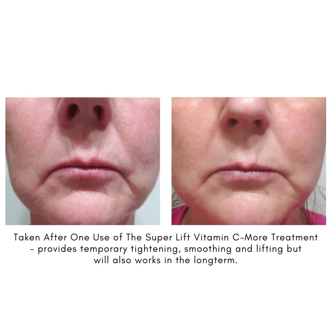 The Super Lift Vitamin C-More Treatment - Beauty Heroes®