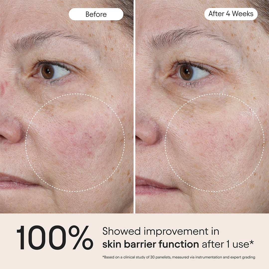 Alpyn Beauty | Barrier Repair Serum | Before and After Use Image - comparison showing the appearance of facial skin before and after four weeks of use
